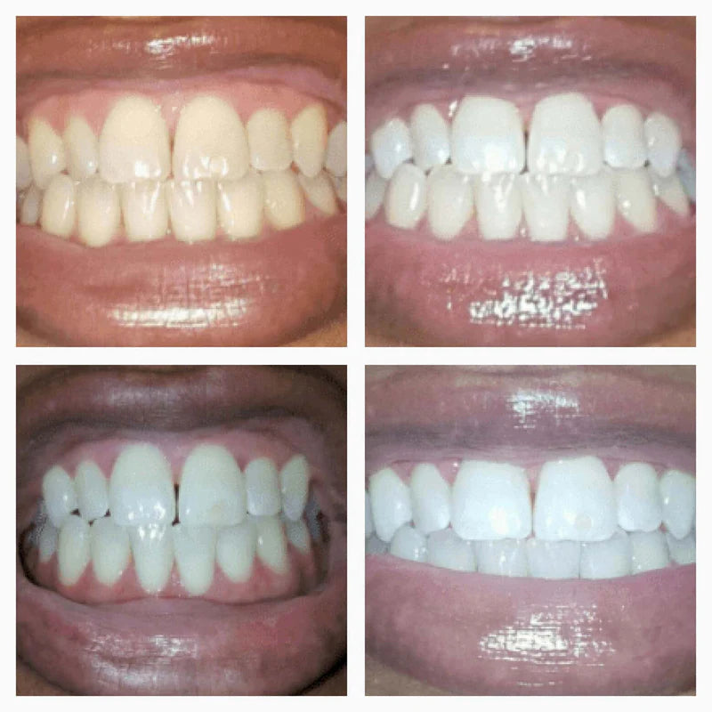 Dental Grade Teeth Whitening Serum